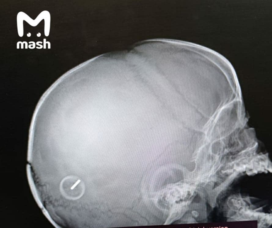 Штырь с колесиком от игрушечной машинку вонзился в голову ребенка