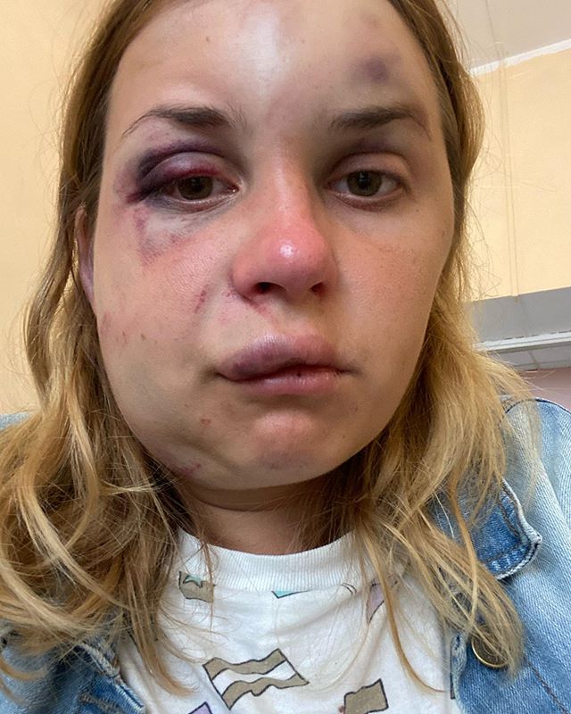 Фото Анастасии Луговой сразу после нападения в поезде "Мариуполь-Киев". Фото: Instagram