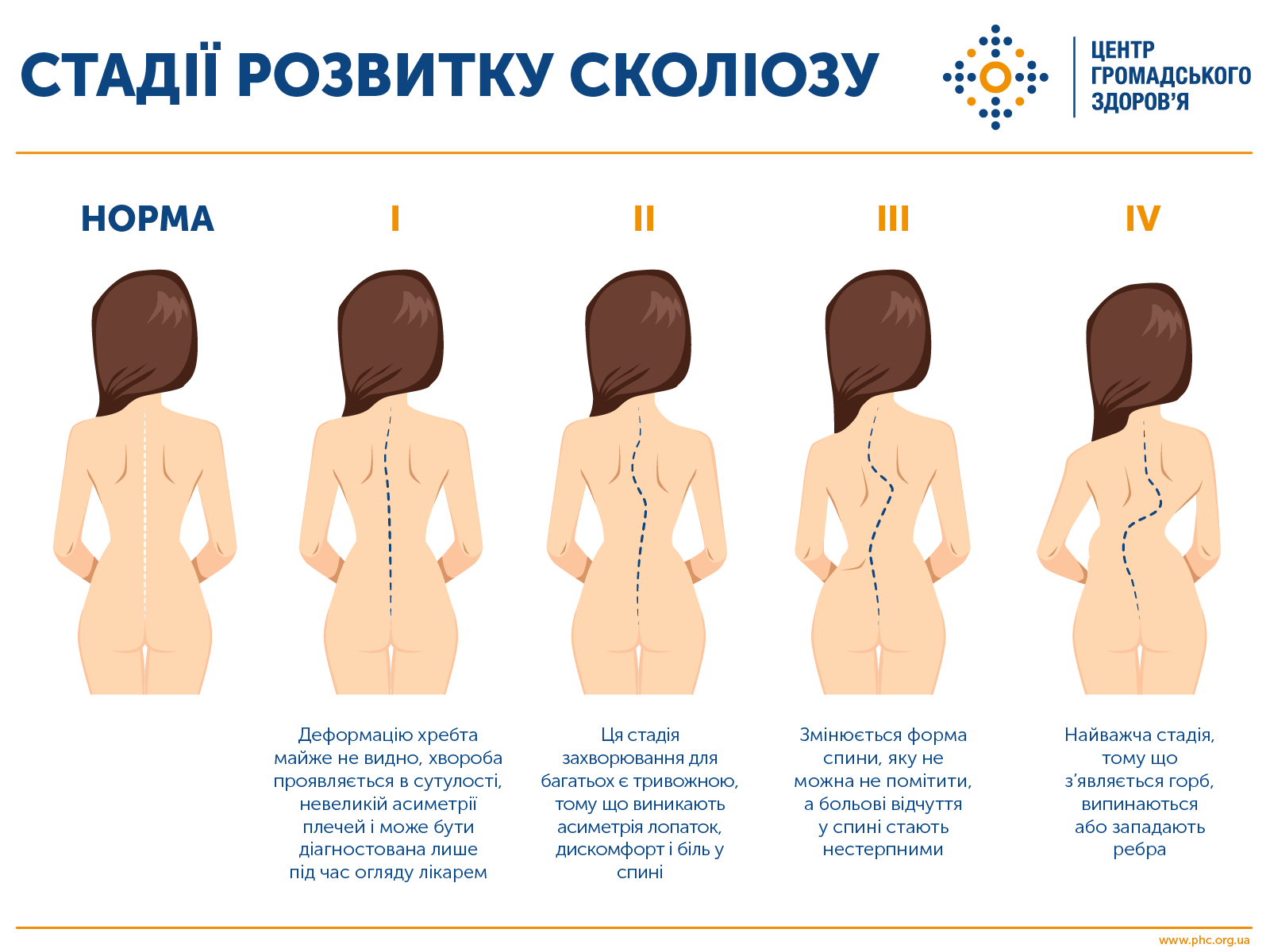 Как избежать сколиоза